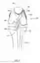 Fig. 02 - Soft Tissue to Bone Fixation