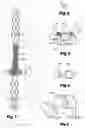 Fig. 02 - Mandibular bone transport reconstruction plate