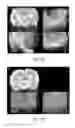 Fig. 02 - METHODS AND COMPOSITIONS FOR USE OF ANGIOGENESIS INHIBITORS IN THE PREVENTION AND/OR CONTROL OF EPILEPSY