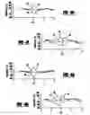 Fig. 04 - Two-Sided Overlapping Coupled Sectorial Loop Antenna