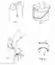 Fig. 02 - Ingrown toenail treatment method