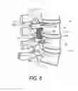 Fig. 07 - SPINE TREATMENT DEVICES AND METHODS