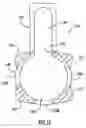 Fig. 13 - Instruments and method for minimally invasive carpal tunnel release
