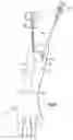 Fig. 28 - Instruments and method for minimally invasive carpal tunnel release