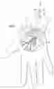 Fig. 30 - Instruments and method for minimally invasive carpal tunnel release
