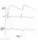 Fig. 02 - Pulse detection method and apparatus using patient impedance