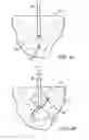 Fig. 03 - Apparatuses and Methods for Interstitial Tissue Removal