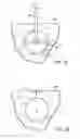 Fig. 04 - Apparatuses and Methods for Interstitial Tissue Removal