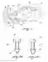 Fig. 02 - Implant capable of forming a differential image in an eye and methods of inserting and locating same