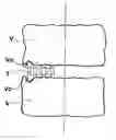 Fig. 01 - Bone Spacer