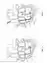 Fig. 07 - Trans-Septal Heart Assist Devices and Methods of Use