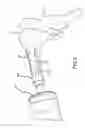 Fig. 06 - COMPRESSIVE COUPLING OF AN IMPLANTABLE HEARING AID ACTUATOR TO AN AUDITORY COMPONENT