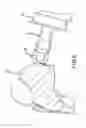 Fig. 09 - COMPRESSIVE COUPLING OF AN IMPLANTABLE HEARING AID ACTUATOR TO AN AUDITORY COMPONENT