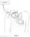 Fig. 02 - IMPLANTABLE MEDICAL DEVICE WITH SENSING ELECTRODES