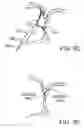 Fig. 14 - Energy based devices and methods for treatment of anatomic tissue defects