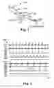 Fig. 02 - Treatment of cardiac arrhythmia by modification of neuronal signaling through fat pads of the heart
