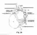 Fig. 09 - Treatment of cardiac arrhythmia by modification of neuronal signaling through fat pads of the heart