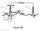 Fig. 05 - Determination of cardiac pacing parameters based on non-localized sensing