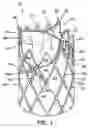Fig. 02 - CARDIOVASCULAR VALVE ASSEMBLY WITH RESIZABLE DOCKING STATION