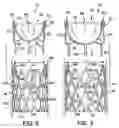 Fig. 03 - CARDIOVASCULAR VALVE ASSEMBLY WITH RESIZABLE DOCKING STATION