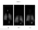 Fig. 03 - Methods for the delivery of a beta2 agonist to induce bronchodilation and formulations for use in the same