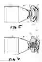 Fig. 04 - Acoustic pressure wave applicator system with conduction pad