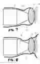 Fig. 05 - Acoustic pressure wave applicator system with conduction pad