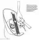 Fig. 01 - Snowmobile plastic windshield stabilizer