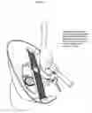 Fig. 08 - Snowmobile plastic windshield stabilizer