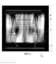 Fig. 04 - Histogram calculation for auto-windowing of collimated X-ray image