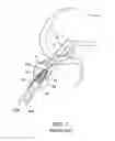 Fig. 02 - Soft tissue sock enhancement devices
