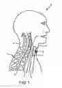 Fig. 02 - Tracheostoma spacer, tracheotomy method, and device for inserting a tracheostoma spacer