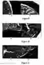 Fig. 05 - Method for treating and/or preventing intestinal bacterial imbalance