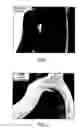 Fig. 02 - Medical device coated with a coating containing elastin pentapeptide VGVPG