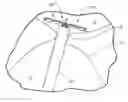 Fig. 01 - Devices for reducing the size of an internal tissue opening
