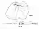 Fig. 10 - Devices for reducing the size of an internal tissue opening
