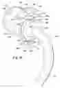 Fig. 08 - Ventilator to tracheotomy tube coupling