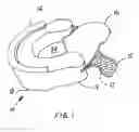 Fig. 02 - Mouth appliance for mitigating sleep related problems