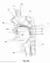 Fig. 22 - Tongue stabilization device and methods of using the same