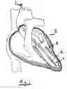 Fig. 02 - System for improving diastolic dysfunction