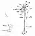 Fig. 01 - DETERMINING THE CENTER OF ROTATION OF AN IMPLANT