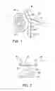 Fig. 02 - DETERMINING THE CENTER OF ROTATION OF AN IMPLANT