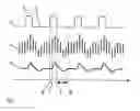 Fig. 02 - Apparatus and computer program for determining a patient's volemic status represented by cardiopulmonary blood volume