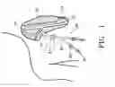 Fig. 02 - Catheter retention assembly and method of use