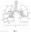 Fig. 02 - Devices, systems, methods and kits for performing selective dissection of lung tissue