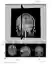 Fig. 06 - System and method for flattened anatomy for interactive segmentation and measurement