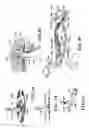 Fig. 06 - Apparatus and method for developing an anatomic space for laparoscopic hernia repair and patch for use therewith