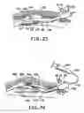Fig. 09 - Apparatus and method for developing an anatomic space for laparoscopic hernia repair and patch for use therewith