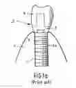 Fig. 02 - Intra-osseous implant
