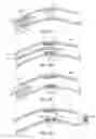 Fig. 03 - ENDOPROSTHESIS CONTAINING MAGNETIC INDUCTION PARTICLES